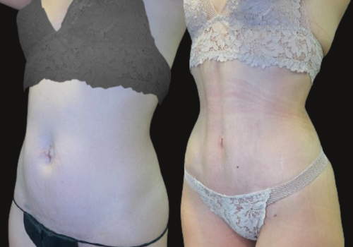 Abdominoplastia 1
