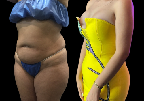 Abdominoplastia 2