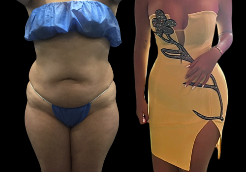 Abdominoplastia 3