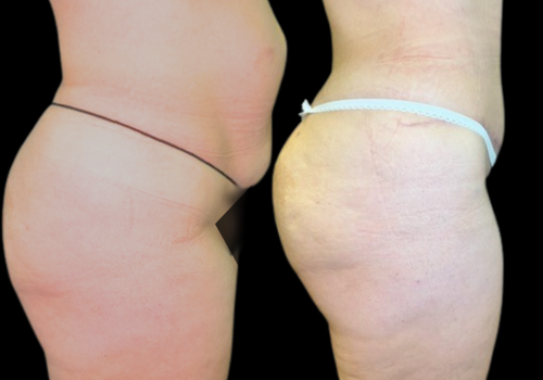 Abdominoplastia 4