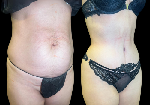 Abdominoplastia 5