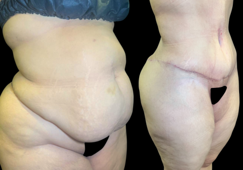 Abdominoplastia 6