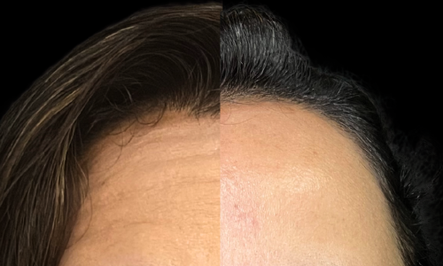 Aplicación de botox